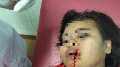 Tagih Hutang, Bibir RY Pekerja Cafe Dibacok Temannya